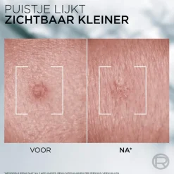 Best L'Oréal Paris L'Oréal Men Expert Derma Control Pimple Paste - 45ML